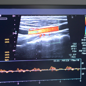 Vascular Ultrasound