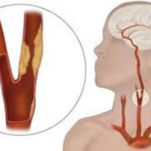 carotid artery disease.