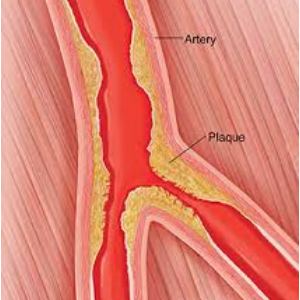 atherosclerosis