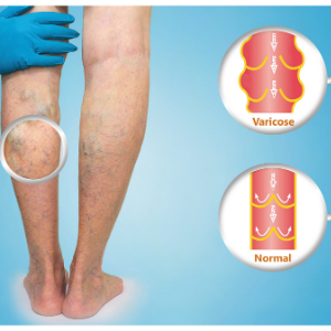 varicose spider veins