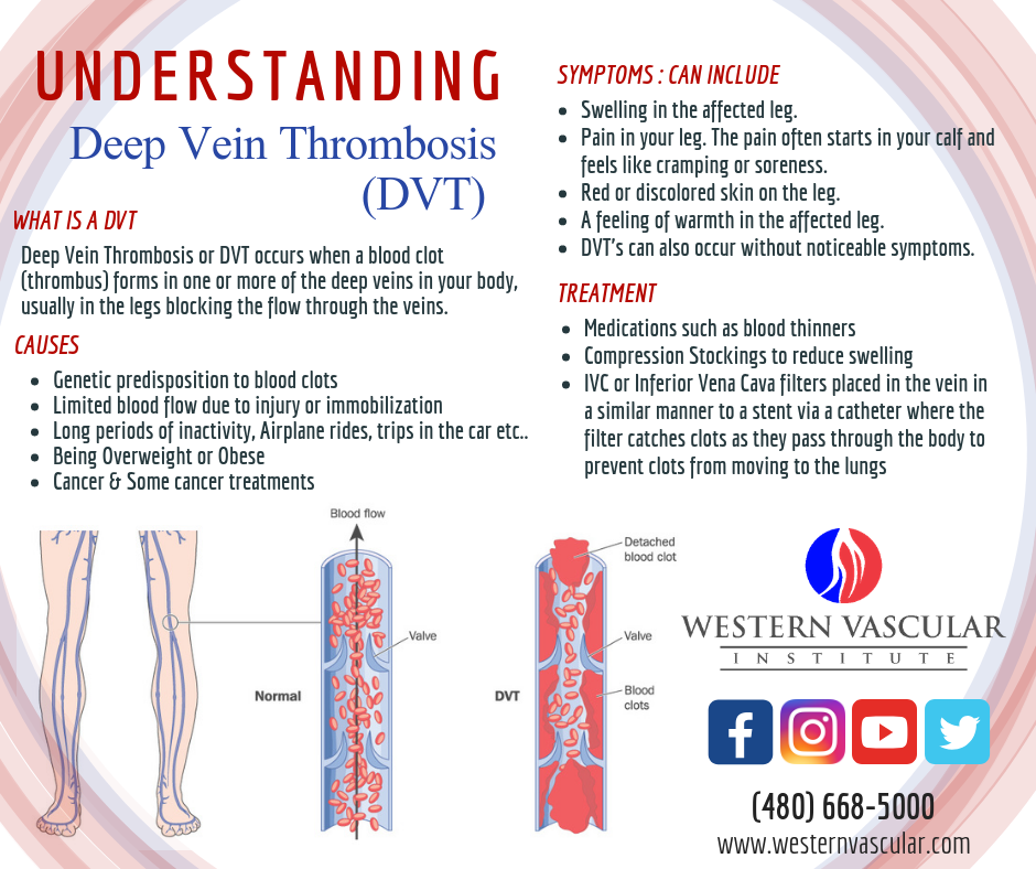 Deep Vein Thrombosis Treatment in Phoenix, Arizona