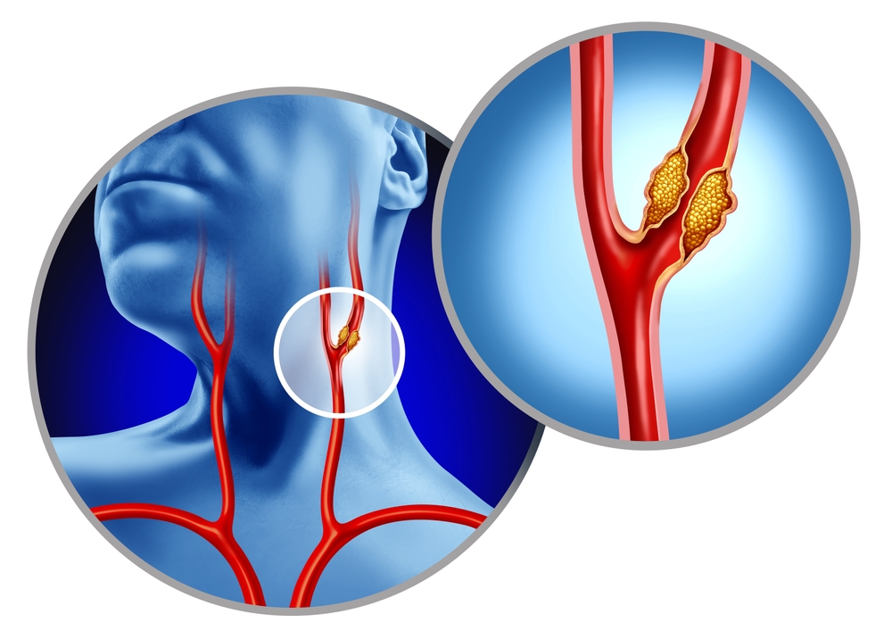 carotid artery disease.